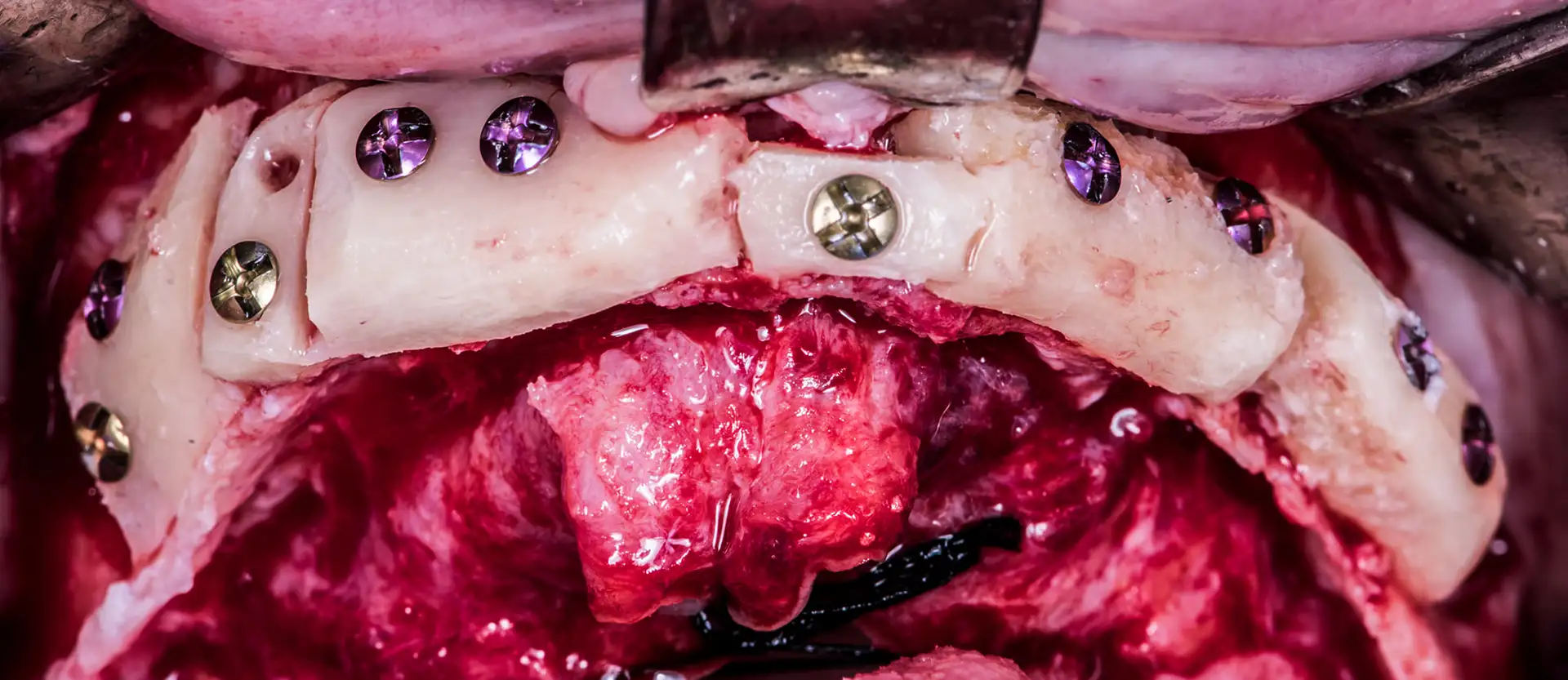 Fachowa rekonstrukcja szczęki z wykorzystaniem autogenicznego materiału kostnego, ilustrująca zaawansowane procedury w chirurgii stomatologicznej